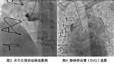 傅国胜:静脉桥血管闭塞介入手术1例